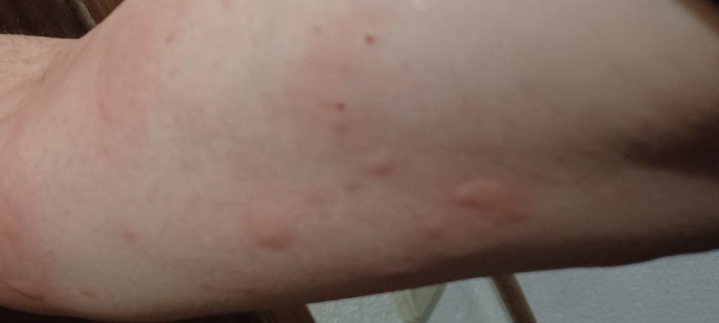 2025-07-21 - Eu mordido mais de 400x por mosquitos...